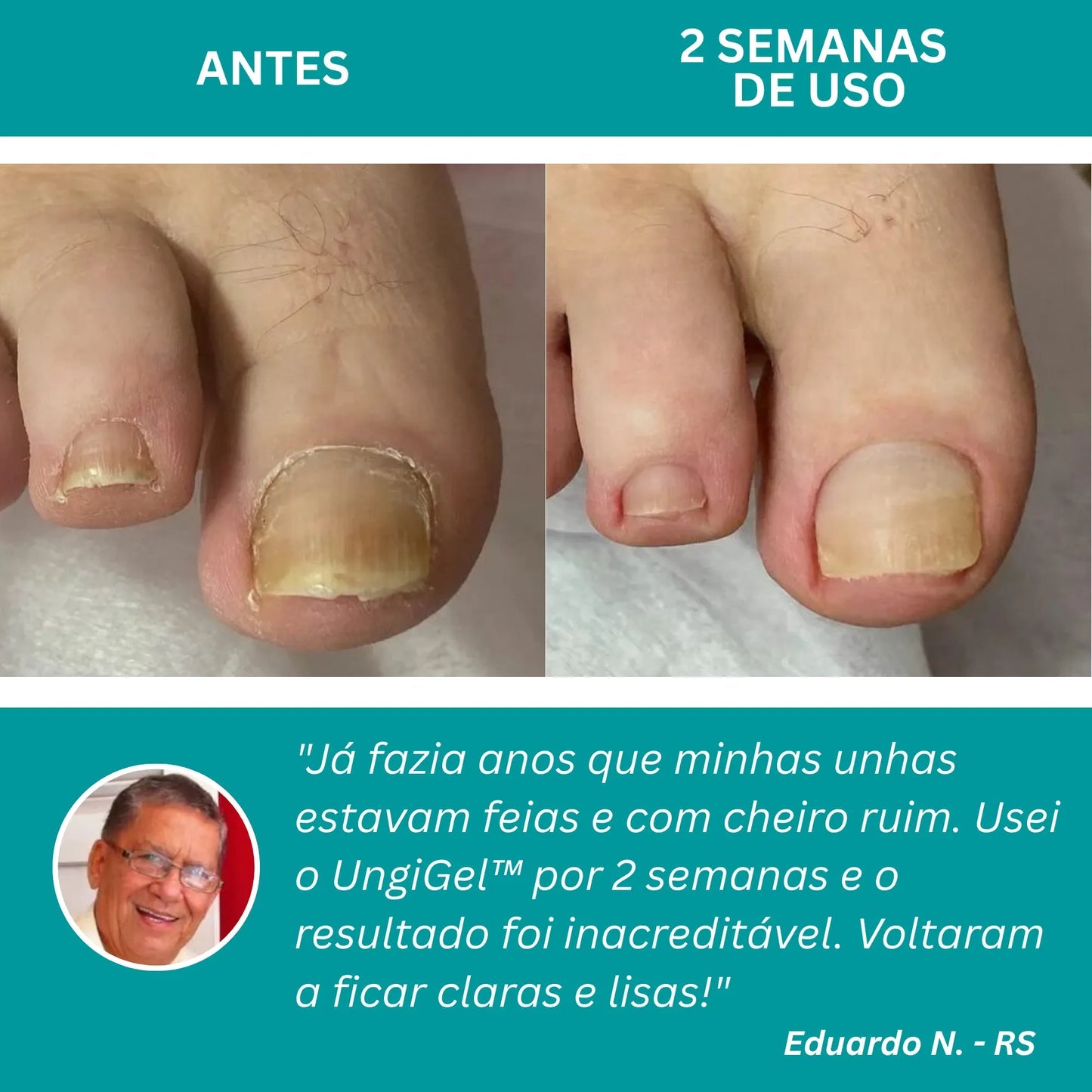 Adesivo antifúngico para unhas - Nail Shield™