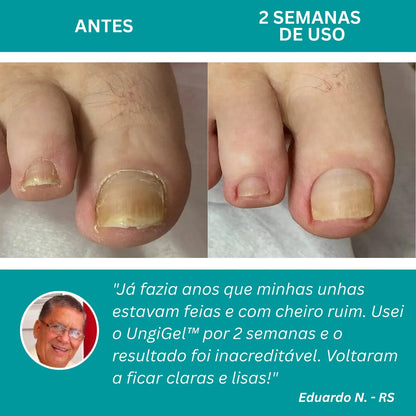 Adesivo antifúngico para unhas - Nail Shield™