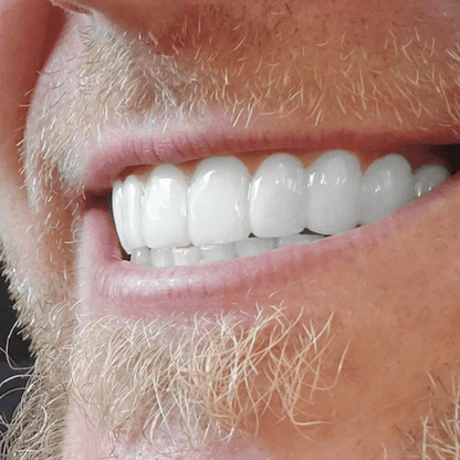 EasySmile | Facetas dentárias de cerâmica personalizadas (conjunto superior e inferior)